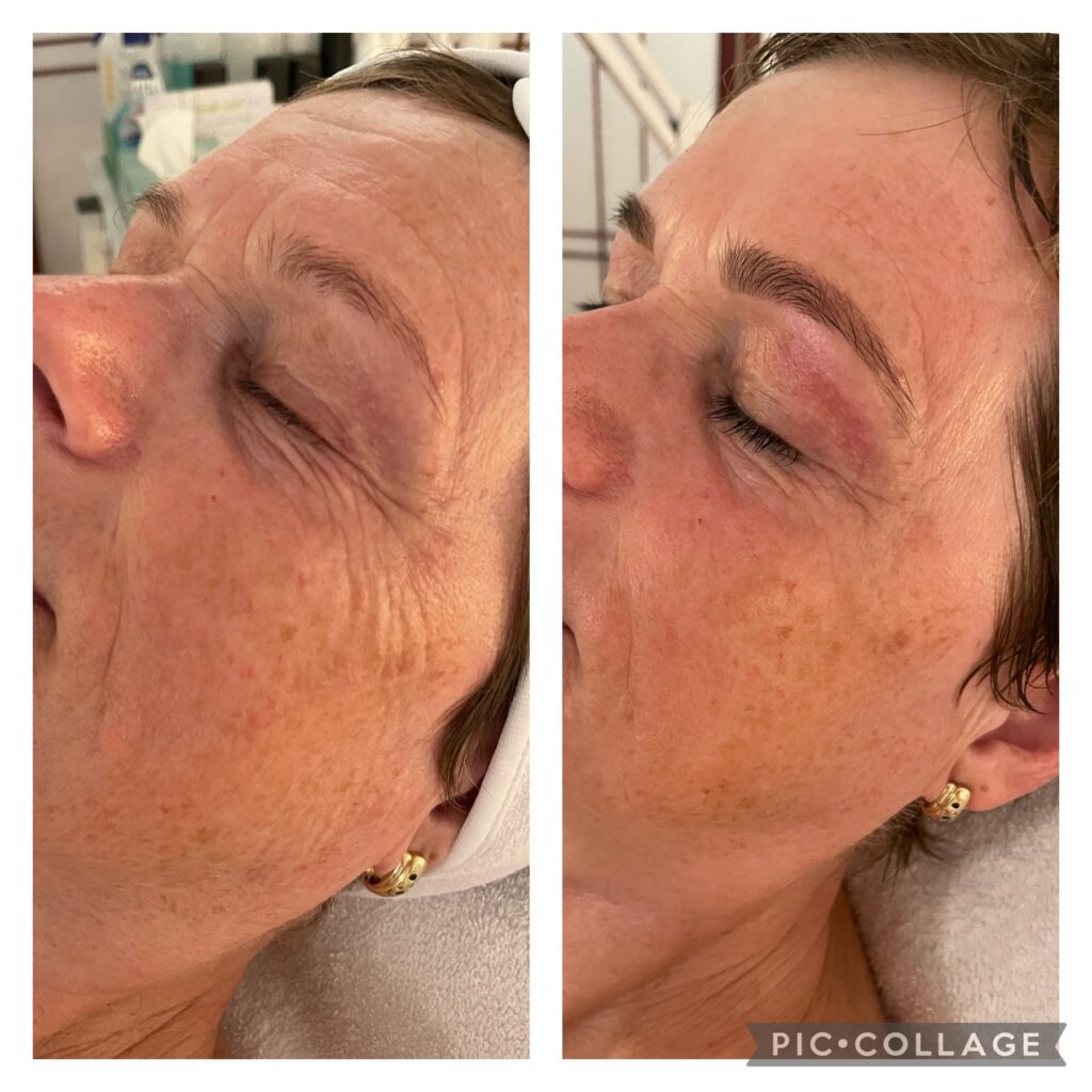 vor und nach einer aktiven Anti-Aging Gesichtsbehandlung